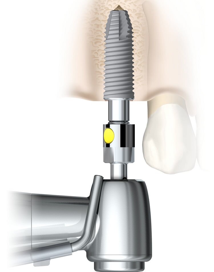 implant